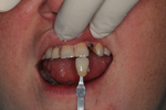 Implant-with-porcelain-crown-Before-Image