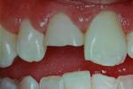 Tooth-colored-filling-Before-Image