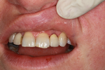 Implant-with-porcelain-crown-After-Image