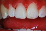 Tooth-colored-filling-After-Image