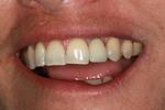 Dental-Implant-restoration-After-Image