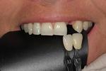 Dental-Implant-restoration-Before-Image