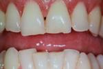 Tooth-colored-fillings-Before-Image